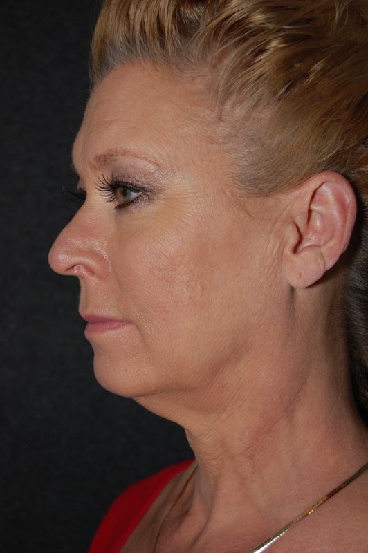 patient before Blepharoplasty (Eyelid Surgery) treatment