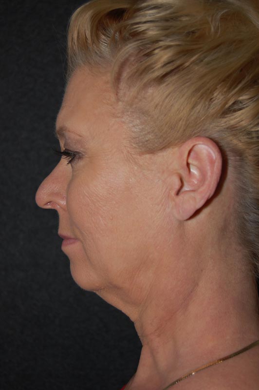 patient before Blepharoplasty (Eyelid Surgery) treatment