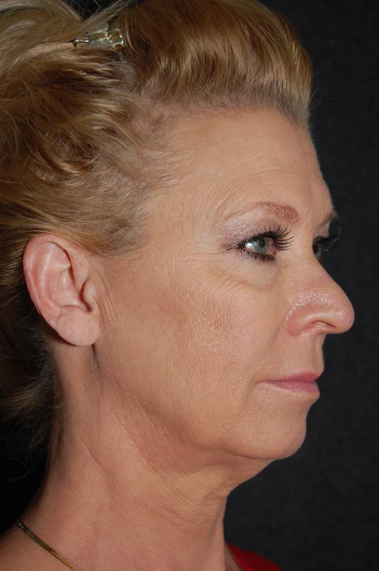 patient before Blepharoplasty (Eyelid Surgery) treatment
