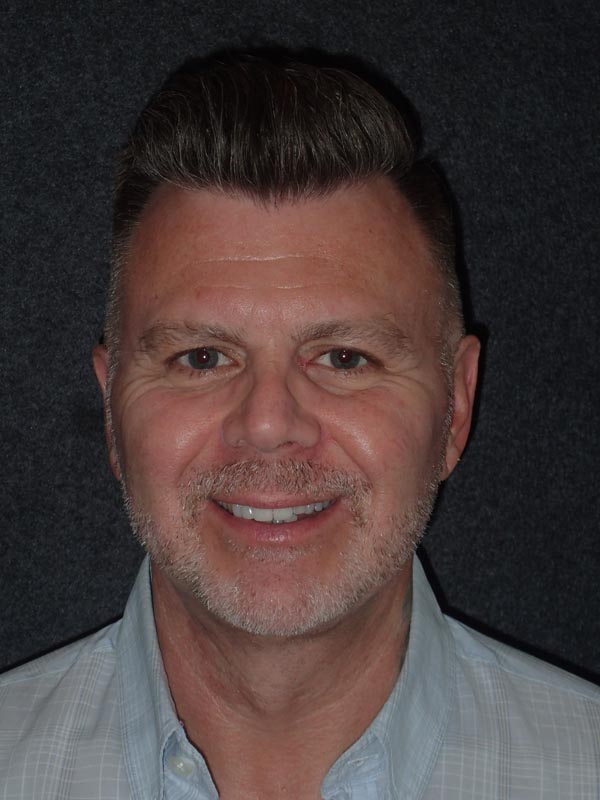 patient after Cervicoplasty (Neck Lift) treatment