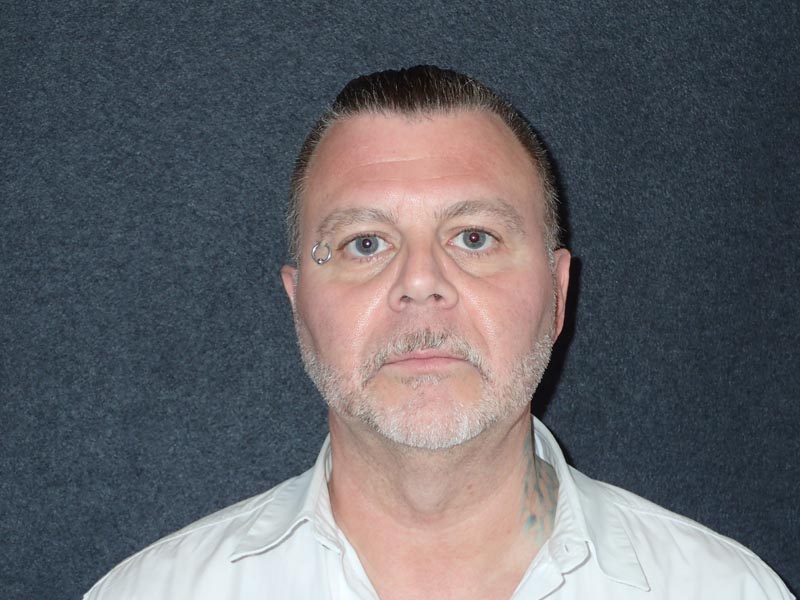 patient before Cervicoplasty (Neck Lift) treatment