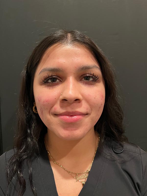 patient after Face Reality Acne Treatment