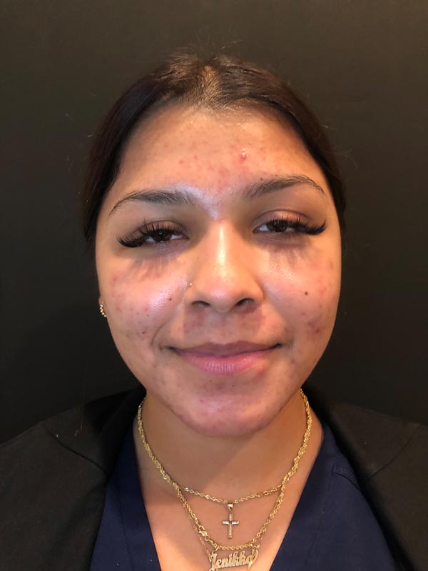 patient before Face Reality Acne Treatment