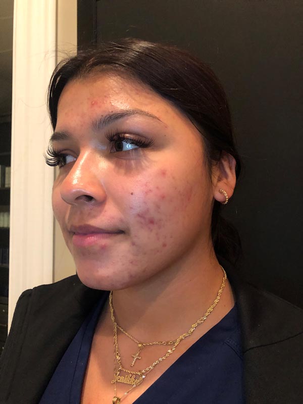 patient before Face Reality Acne Treatment