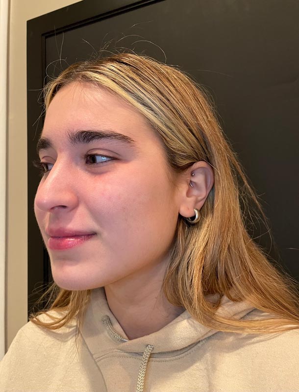 patient after Face Reality Acne Treatment