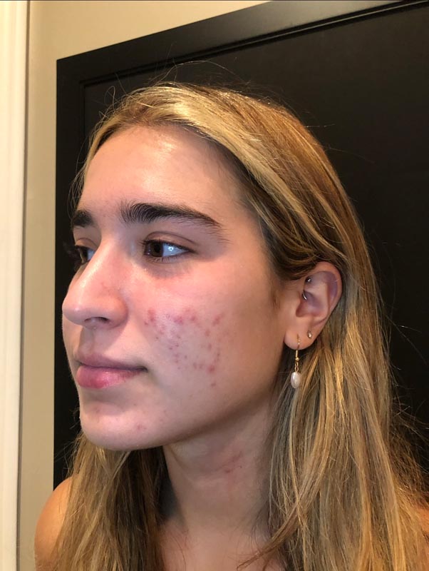 patient before Face Reality Acne Treatment