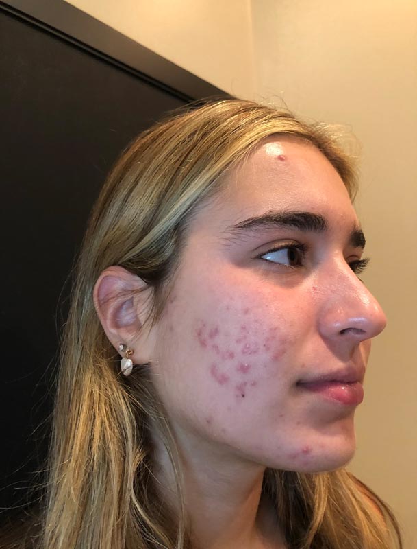 patient before Face Reality Acne Treatment