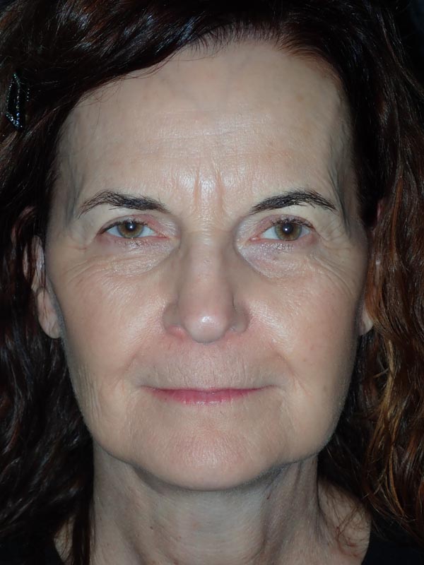 patient after Facelift with Buccal Fat Reduction