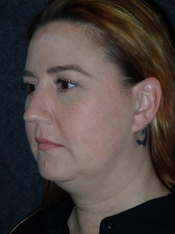 patient before Submental Liposuction & Chin Implant