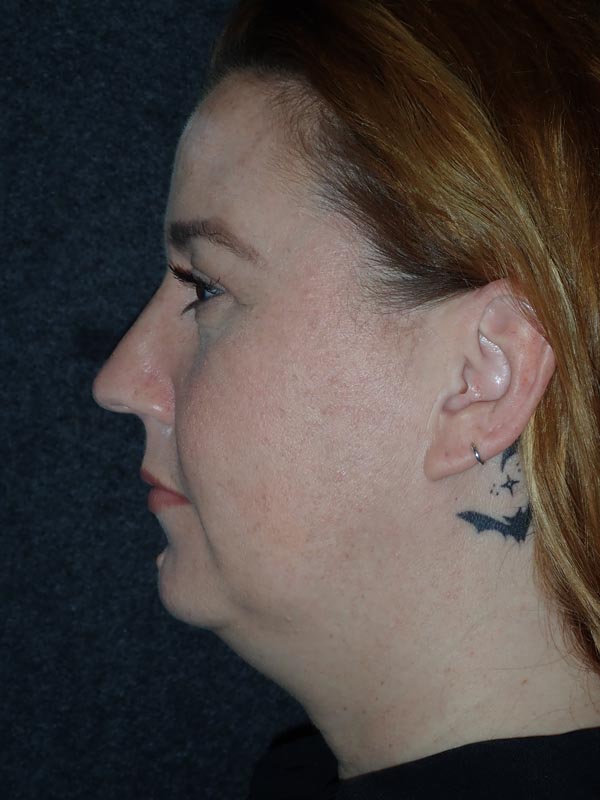 patient before Submental Liposuction & Chin Implant