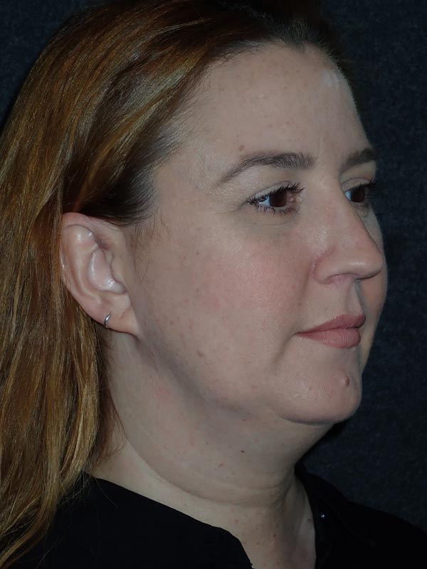 patient before Submental Liposuction & Chin Implant