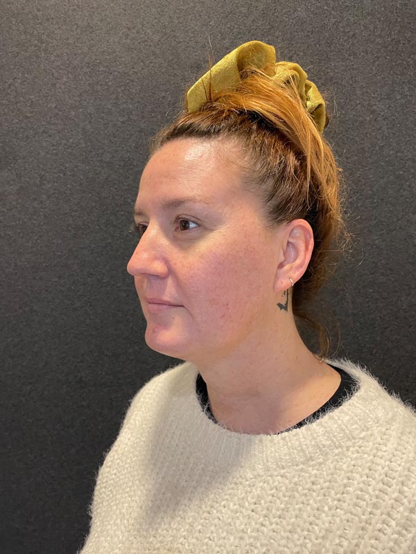 patient after Submental Liposuction & Chin Implant