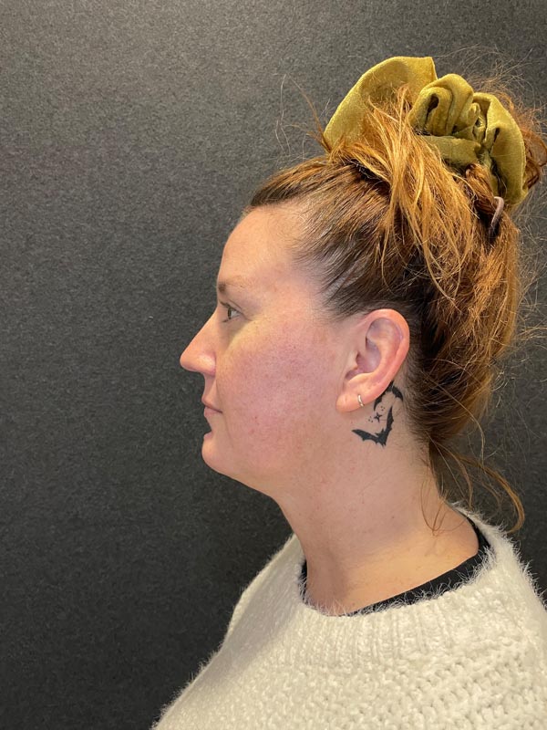 patient after Submental Liposuction & Chin Implant