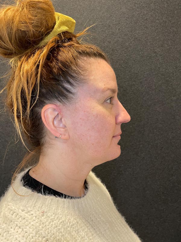 patient after Submental Liposuction & Chin Implant