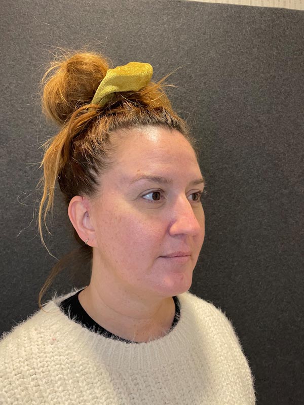 patient after Submental Liposuction & Chin Implant